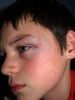 Black eye 2