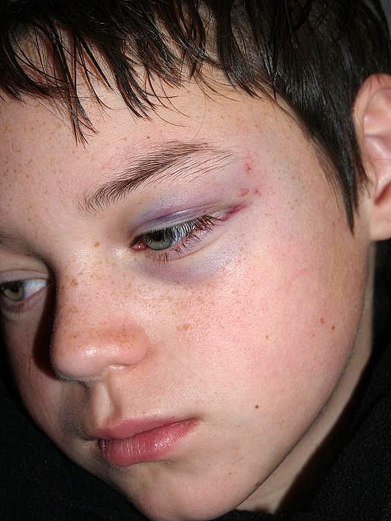 Black eye