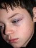 Black eye